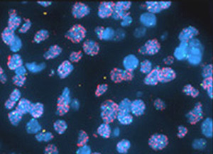 Fluorescence in situ hybridization of a locus-specific EGFR probe and centromere 7 probe (amplified)