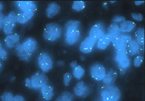 Fluorescence in situ hybridization of a locus-specific EGFR probe and centromere 7 probe (not amplified)