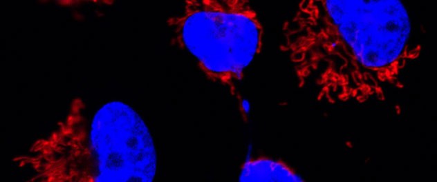 Confocal microscopy image of brain metastatic cells from lung cancer.