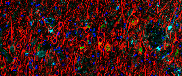 Microscopy of the hippocampus from Alzheimer's disease patients is stained with neuron (red) and astrocyte (cyan) markers. Damaged mitochondria is labeled in green.