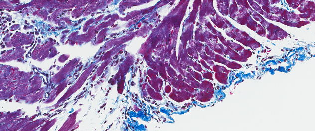 Microscopy image showing fibrosis along the pericardium