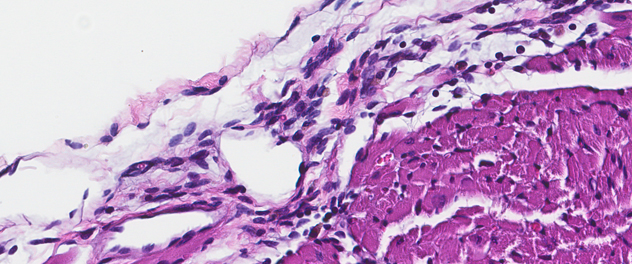 Microscopy image showing pericardial inflammation