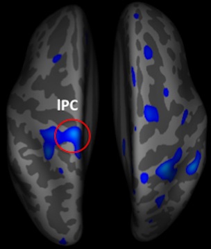 Image illustrates age-related cortical thinning in patients with migraine.