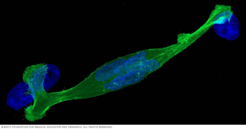 Glioblastoma cell image shows cytoskeletal organization and cellular dynamics during migration.