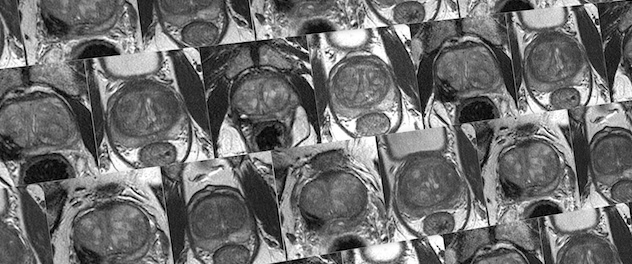 Black and white prostate MRI collage.