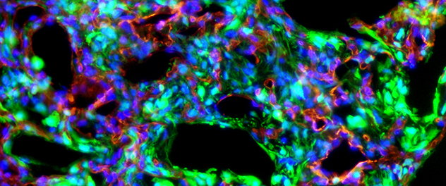 Microscopy of lung tissue showing profound cellular remodeling and fibrosis