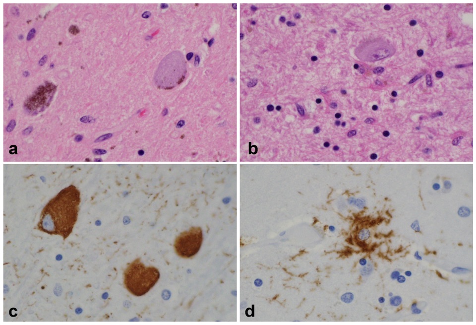 Progressive supranuclear palsy microscopic findings