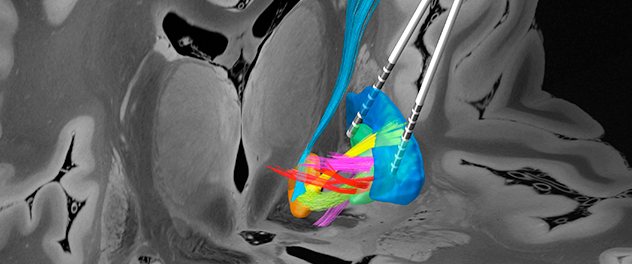 New deep brain stimulation technique