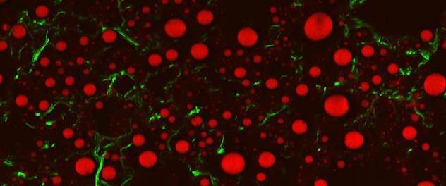 Microscopy showing lipid droplets and tissue scarring in the liver affected by nonalcoholic fatty liver disease (NAFLD).