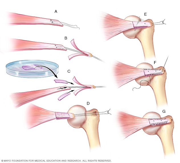 Medical illustration showing surgical procedures using engineered tendon-fibrocartilage-bone composite tissue for rotator cuff repair and regeneration