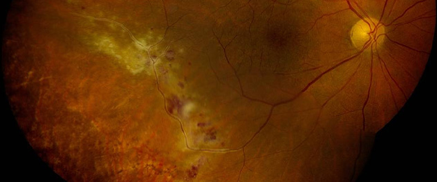 Photograph of a microscopy image of cytomegalovirus retinitis in a transplant recipient