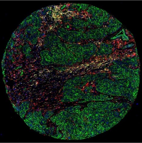 Stained triple-negative breast cancer sample