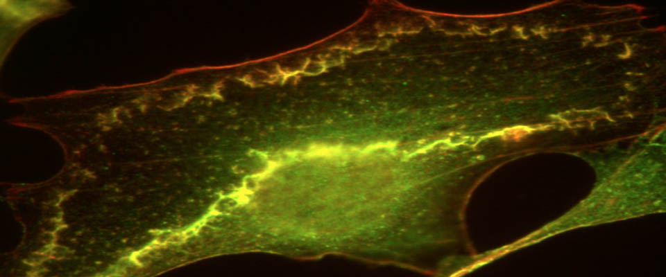 Pancreatic tumor cell showing the actin cytoskeleton and the epidermal growth factor receptor