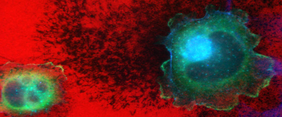 Pancreatic tumor cell modifying and degrading extracellular matrix as it migrates.