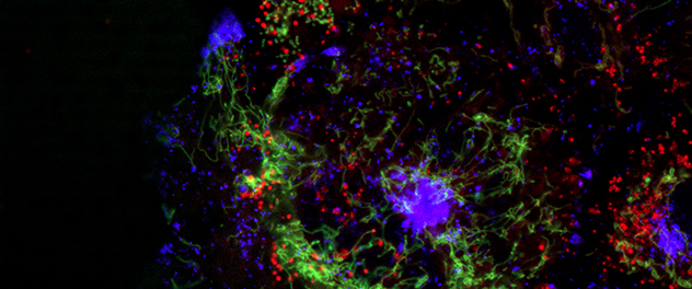 Stained migrating pancreatic cancer cells