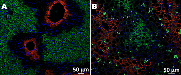 Zonal distribution of steatosis in MASH